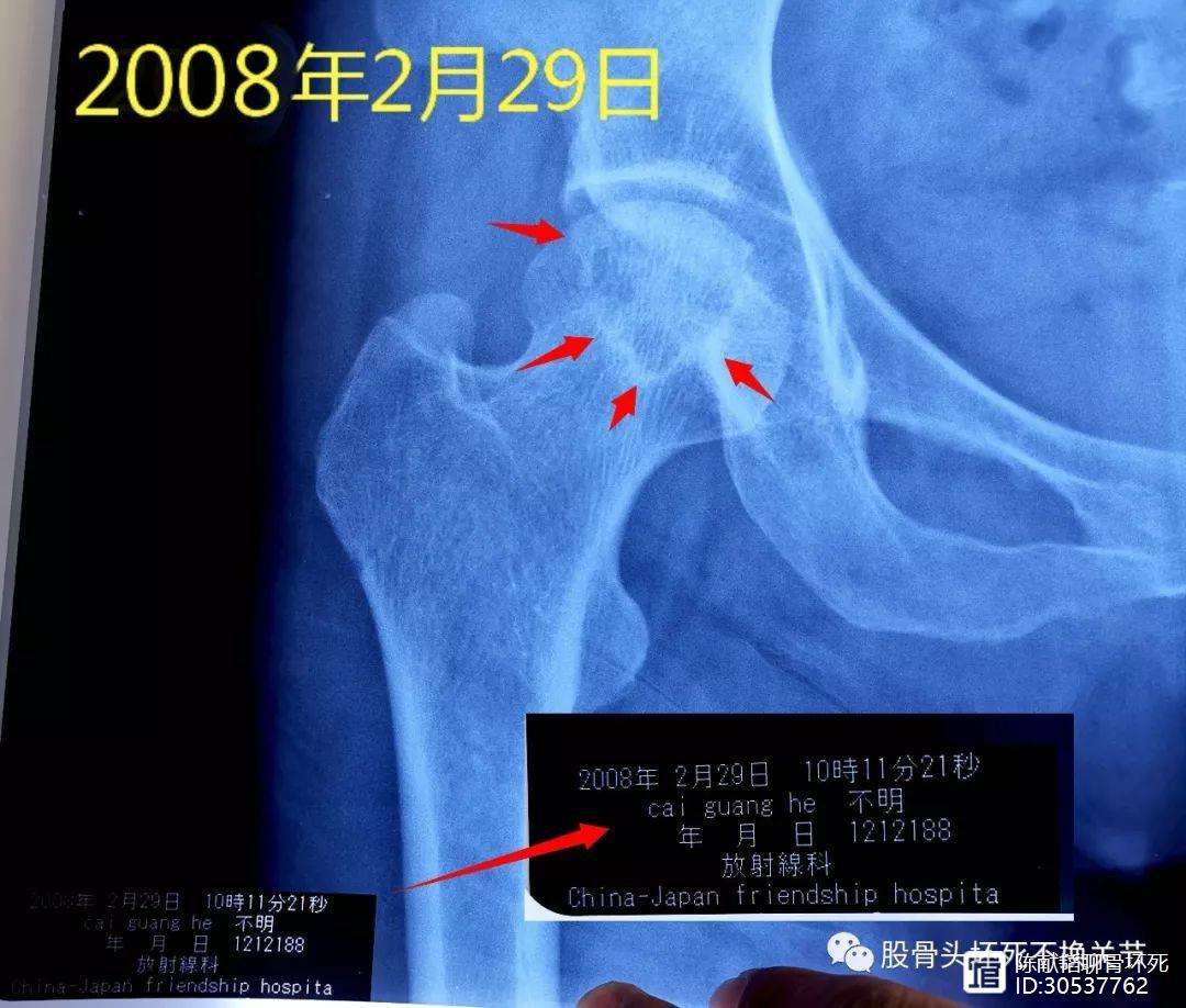 聊城人工骨头医保报销多少(人工骨头医保报销多少比例)