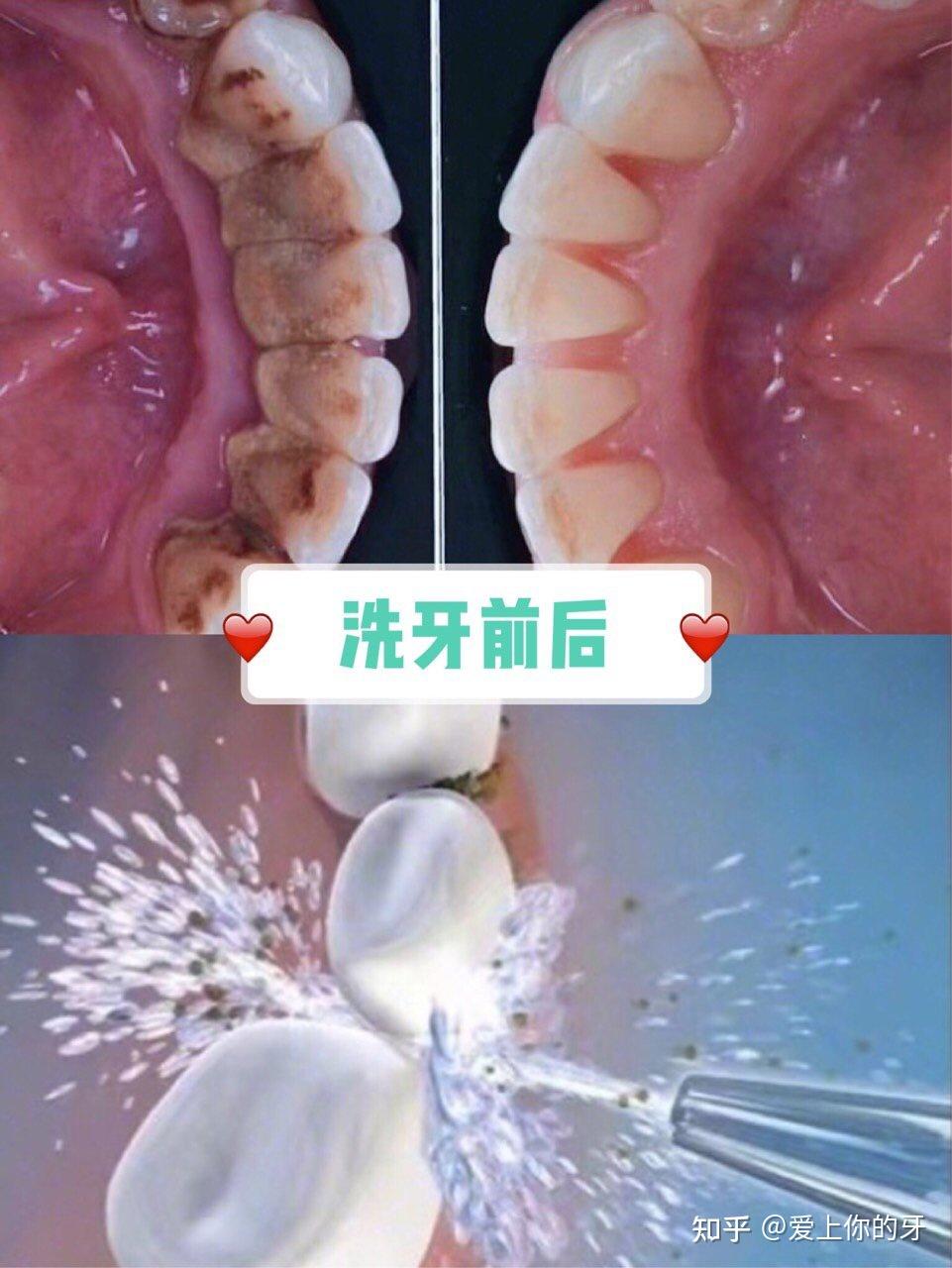 聊城洗牙可以用医保吗(洗牙可以用医保吗,报销比例多少)